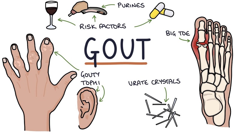 gout