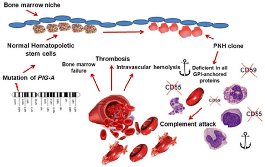 Pathogenesis-of-PNH