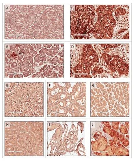 tumors-expressed-ror1